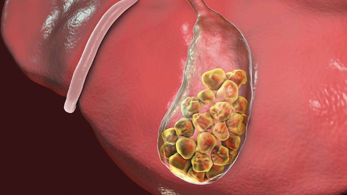 面条|胆囊结石“偏爱”这四类人！看看你中招了没