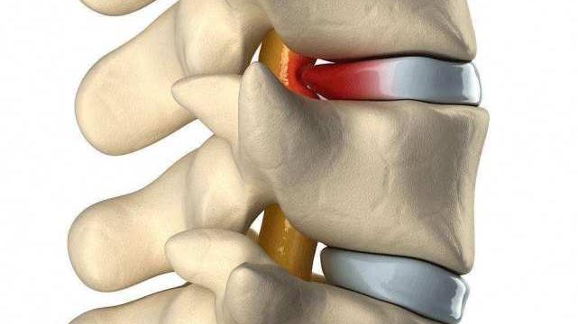 抗癌|如果可以乘坐神舟十四号飞船进入空间站生活，能否把病人的椎间盘突出治愈？---医生遐