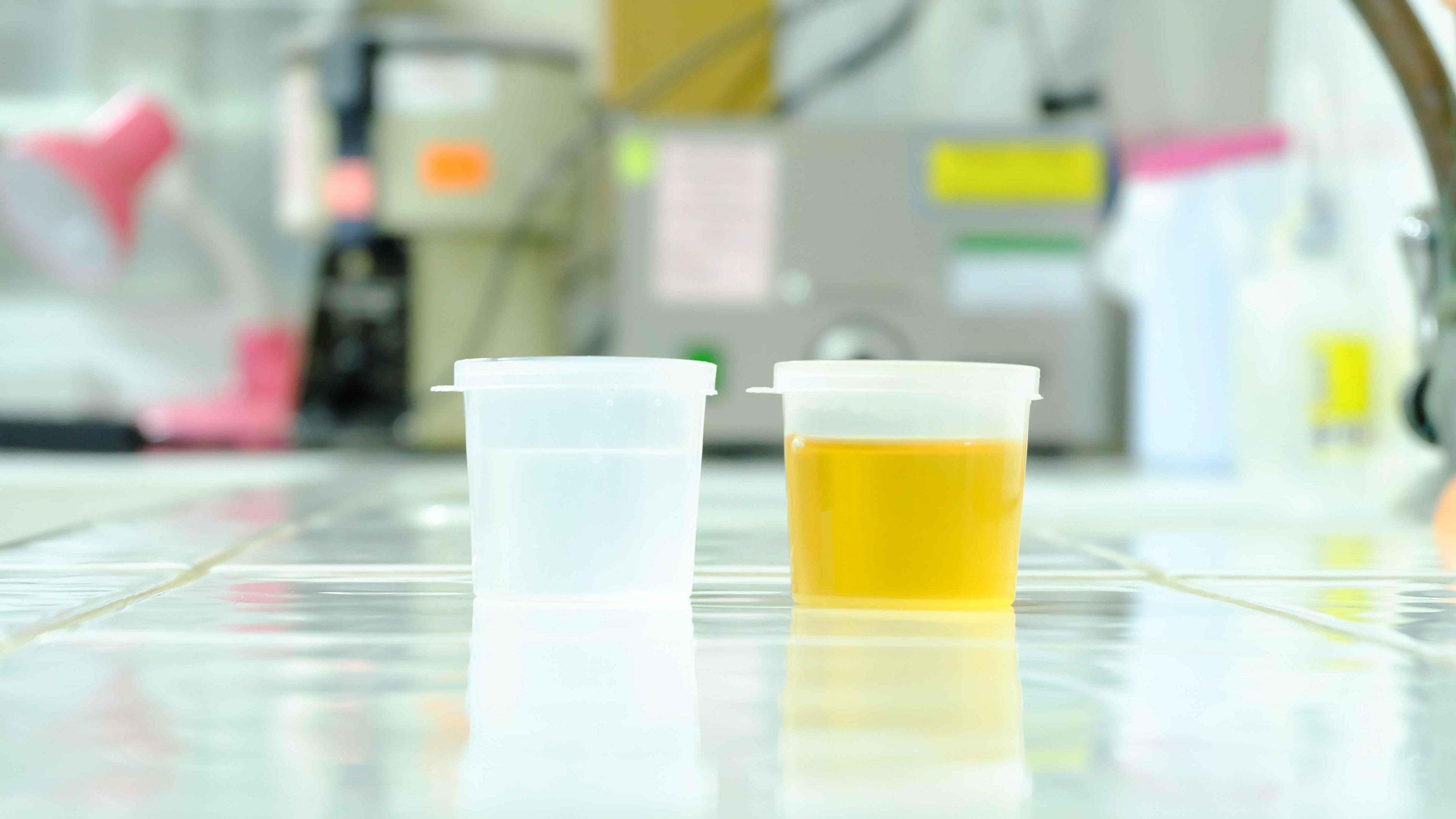 患病|排尿知健康？排尿时若有4种异常，可能是肾出问题了，别不当回事