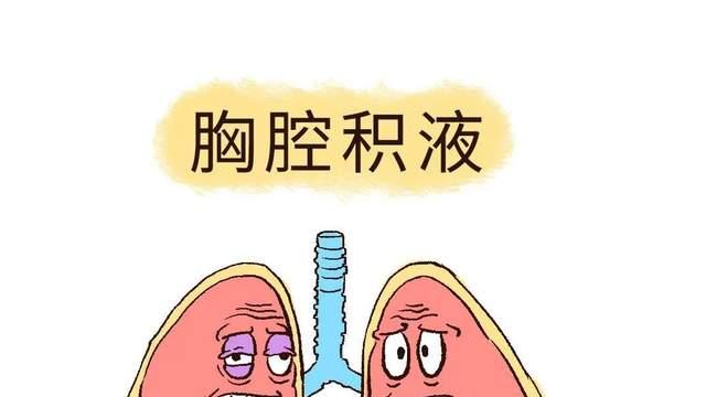 肺癌|恶性胸腔积液是癌症已经扩散的迹象吗？胸腔积液反复怎么办？
