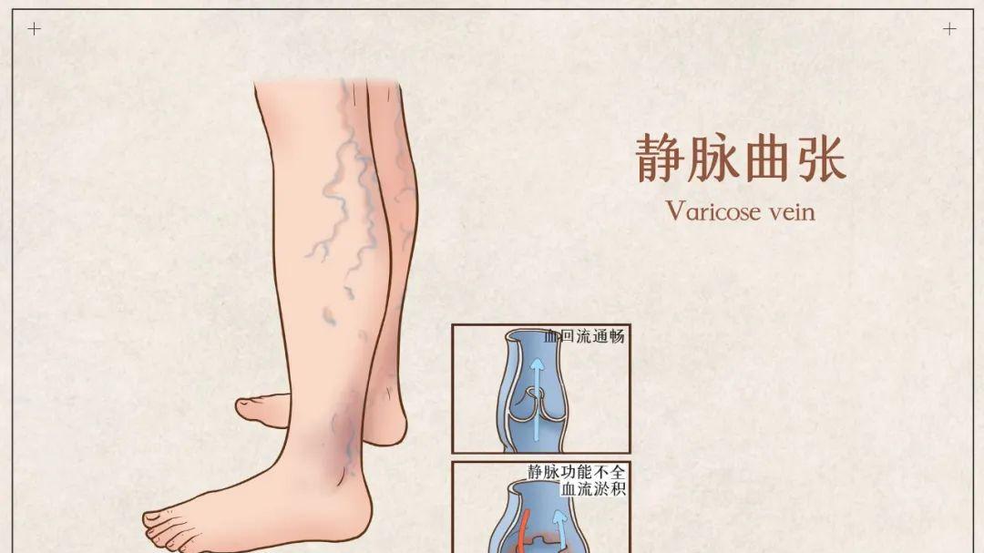 运动|分享一个化解静脉曲张的千古名方，驱散寒邪，赶走瘀滞，打通血脉，改善血管