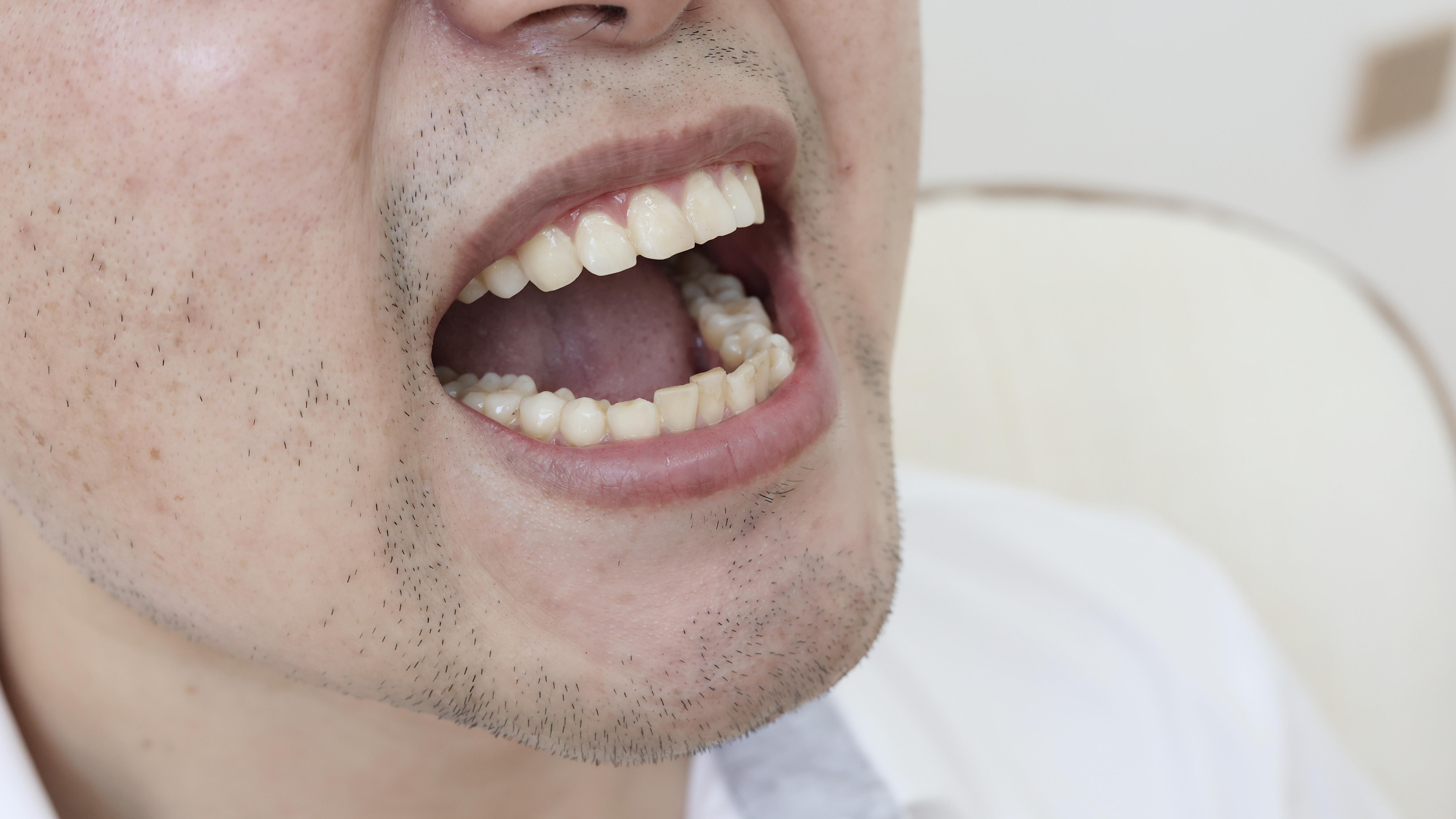 牙齿|烤瓷牙虽能带来诸多好处，但如果没做好，究竟会带来哪些后遗症？