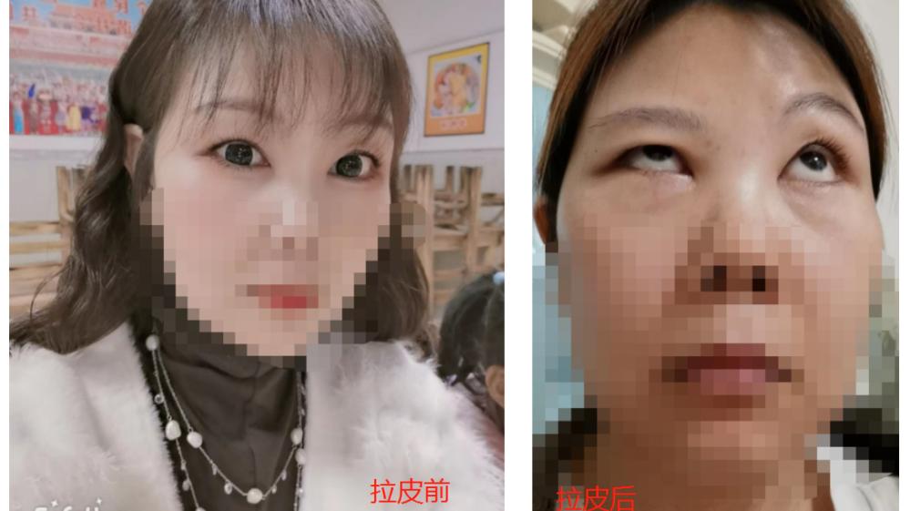 美容|花钱美容还是毁容？美容院还想推脱！