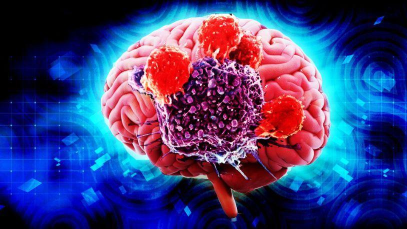 脑肿瘤|男子从确诊到去世仅半年，劝告：出现四种不适，或是脑瘤在作祟