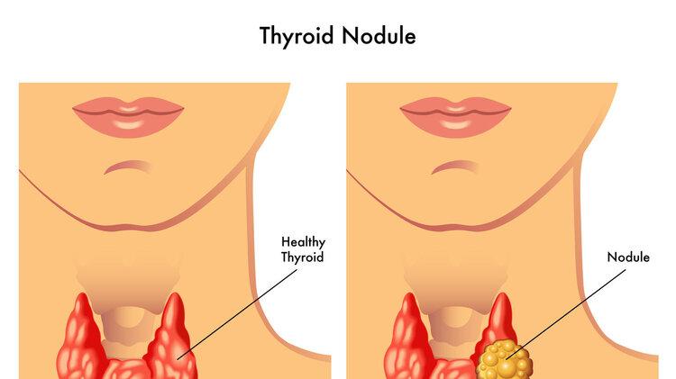 牛肉|牛肉是“结节催化剂”？提醒：不想结节恶化，尽量少吃这4种食物
