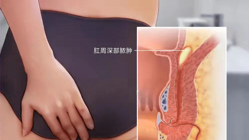 咳嗽|肛周脓肿的危害，远比你想像的更可怕！