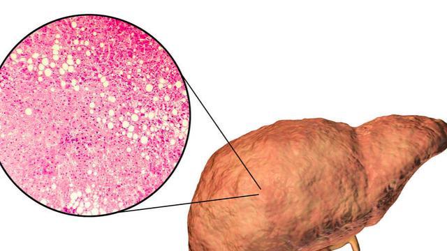 |肝脏脂肪与腹部脂肪，哪个才是糖尿病关键因素？不要搞错了