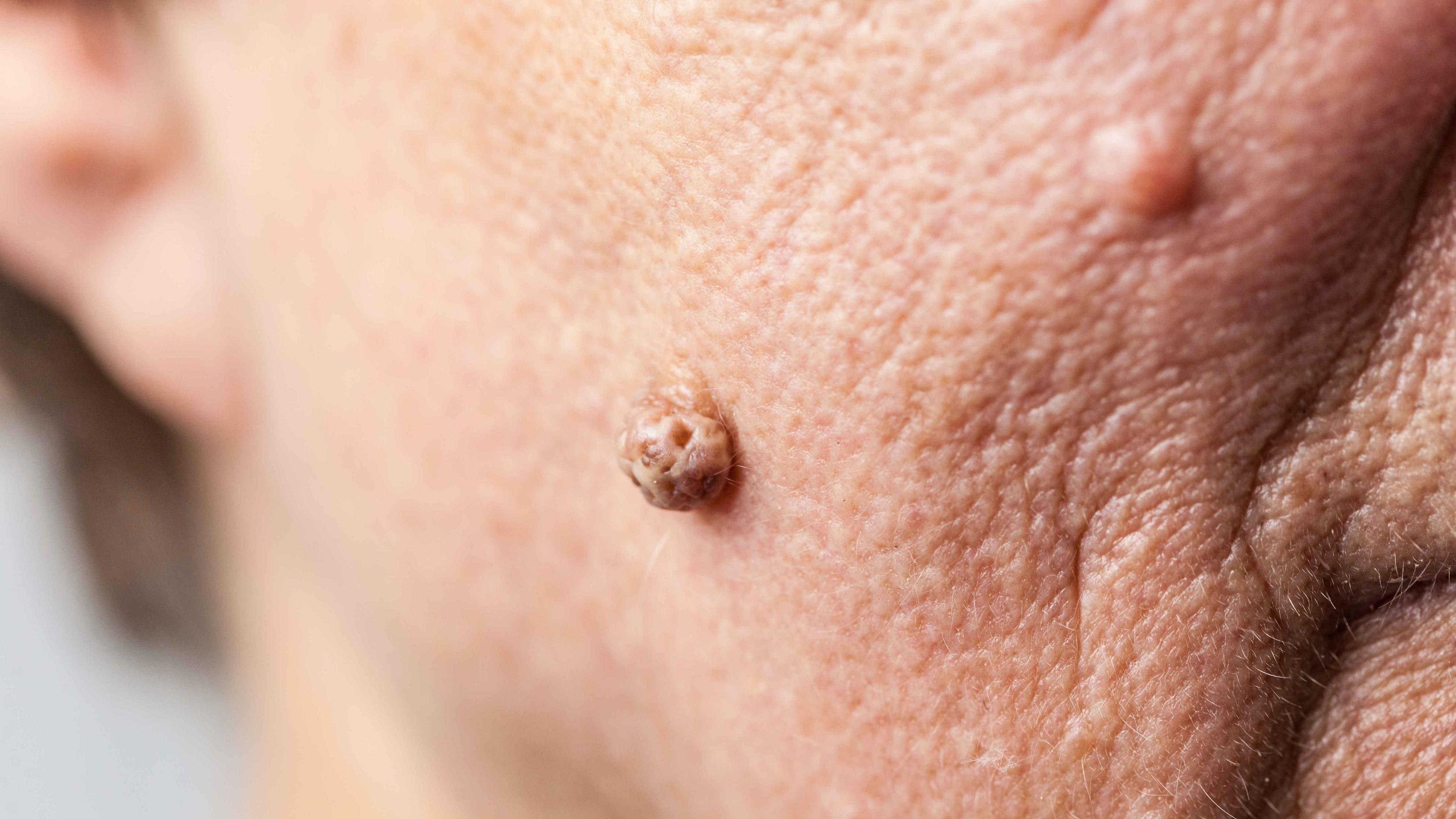 熬夜|皮肤有癌，痣会告知？若突然出现这5种痣，当心可能会发生癌变