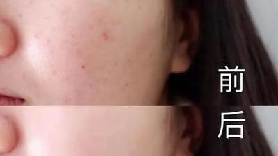 睡眠|一篇文章教你辨认闭口，解决闭口