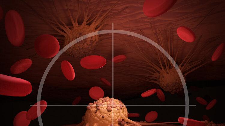 胃癌|啥是重复癌？10年5次癌症！24岁女孩胃癌手术不久，又要面对肺癌