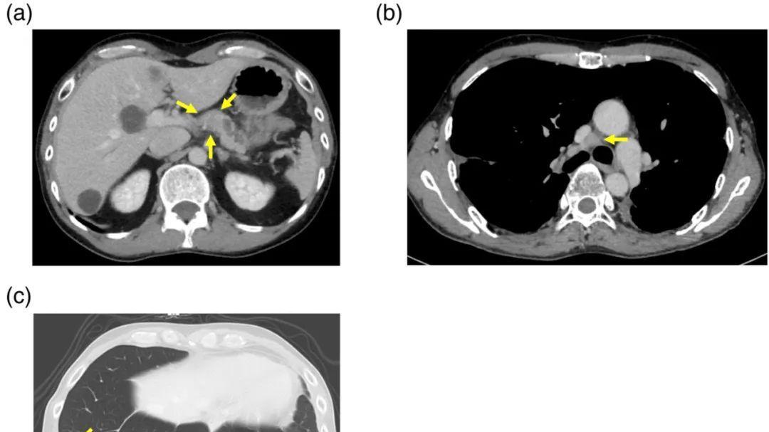 运动|「案例」罕见突变肺癌患者竟奇迹存活超20年！抗癌经验值得借鉴！