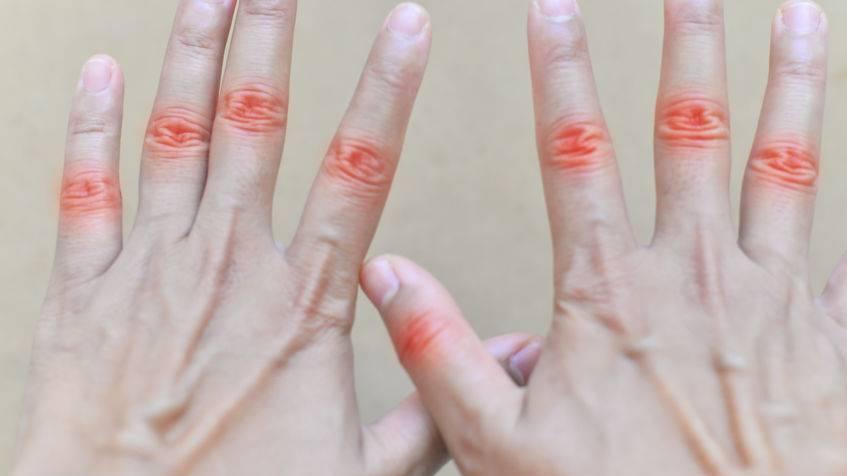 便秘|尿酸高不能吃肉？医生：可以吃，但需做好这些，否则尿酸会波动！