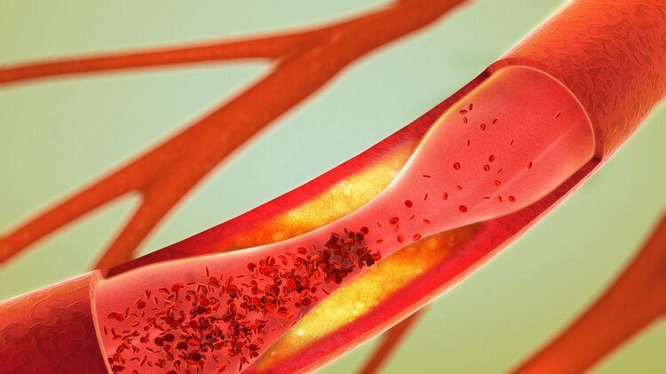 胆囊|老年人睡觉时腿抽筋，是缺钙吗？错！还有这4个原因，别轻易忽视