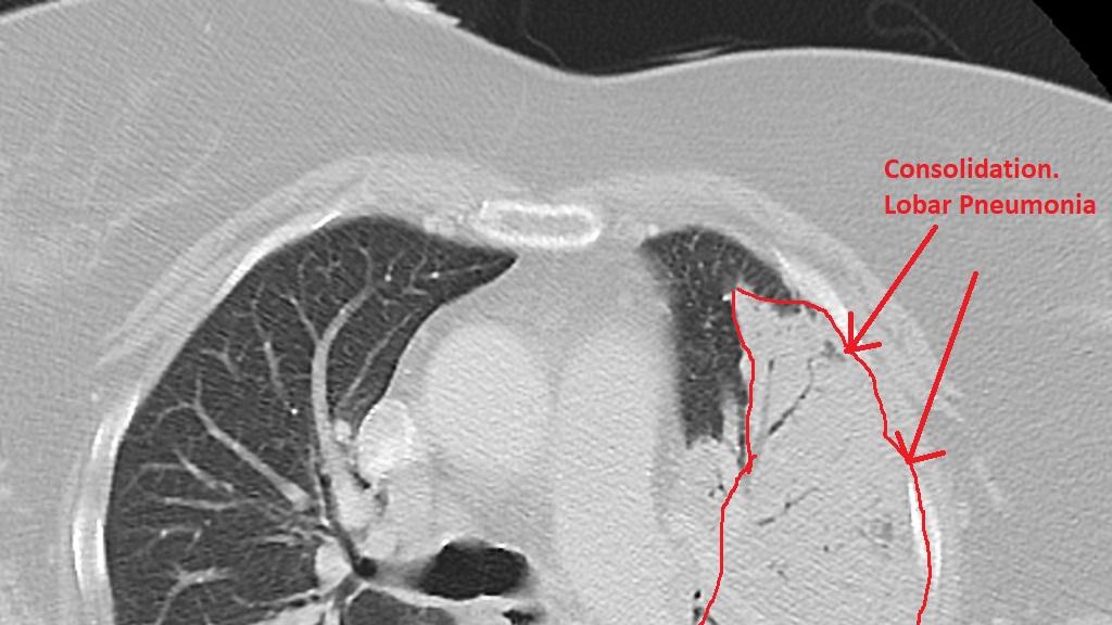 在家肺炎了，能不能用阿奇霉素？医生：大家都在用，却很容易用错