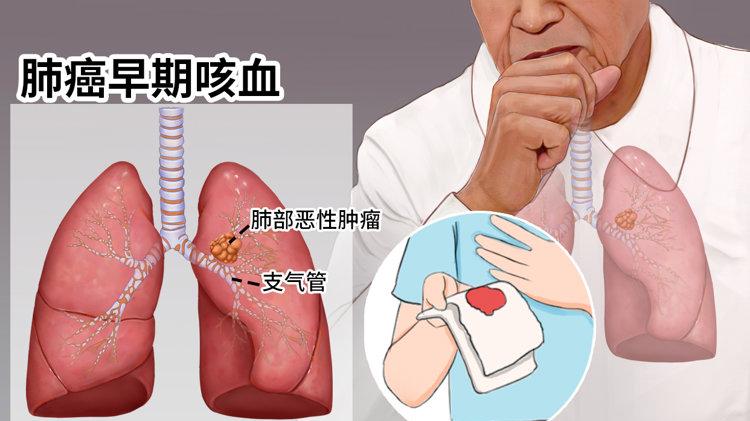 肺癌多是“拖”出来的？提醒：身体有这4个表现，或是肺部在呼救