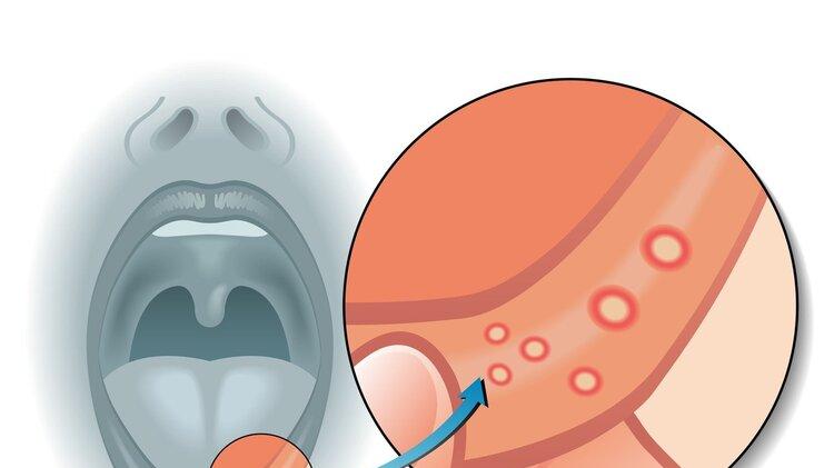水中毒|心火、胃火、肝火、肺火、肾火，身体会出现哪些改变？该怎么降火