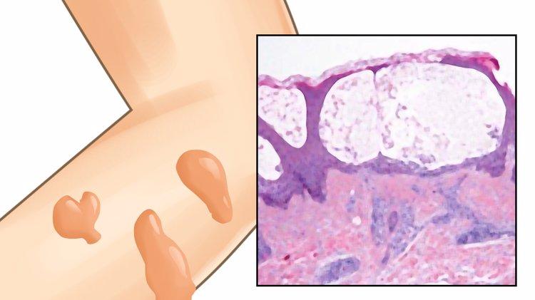 肺癌|54岁男子双脚水肿，诊断肾病，直到出现咳嗽才发现是肺癌