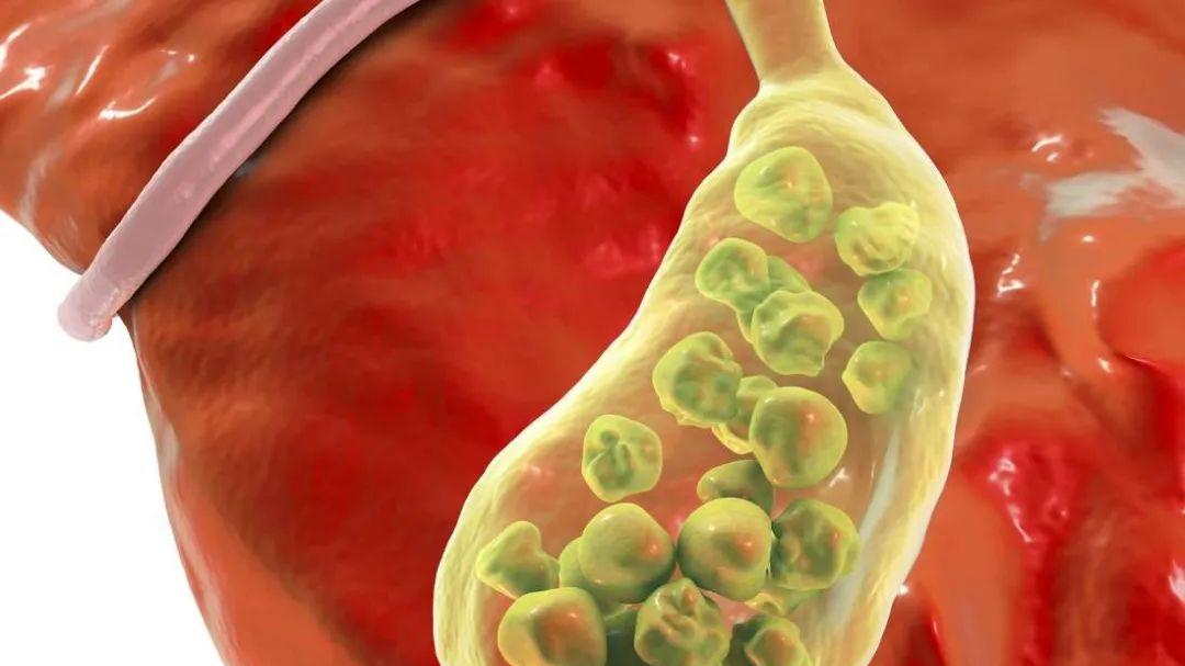 胆结石胆囊炎患者饮食注意什么