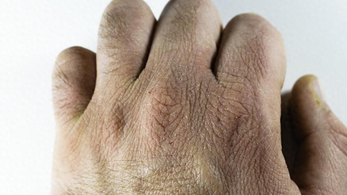 脱衣服时腿上都有很多皮屑脱落？医生提醒：这种维生素该补了