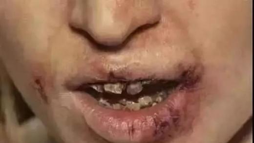 吸食冰毒为什么会牙齿脱落、烂掉！有没有解决的办法？
