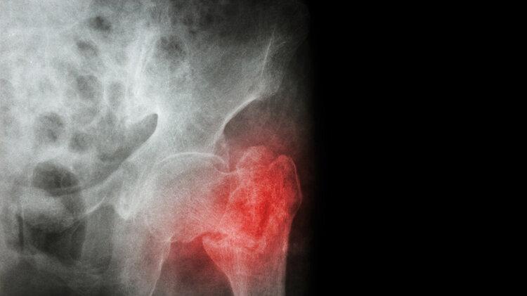 老人摔一跤就骨折？提醒：老人多补充2种营养，或降低14%髋部骨折