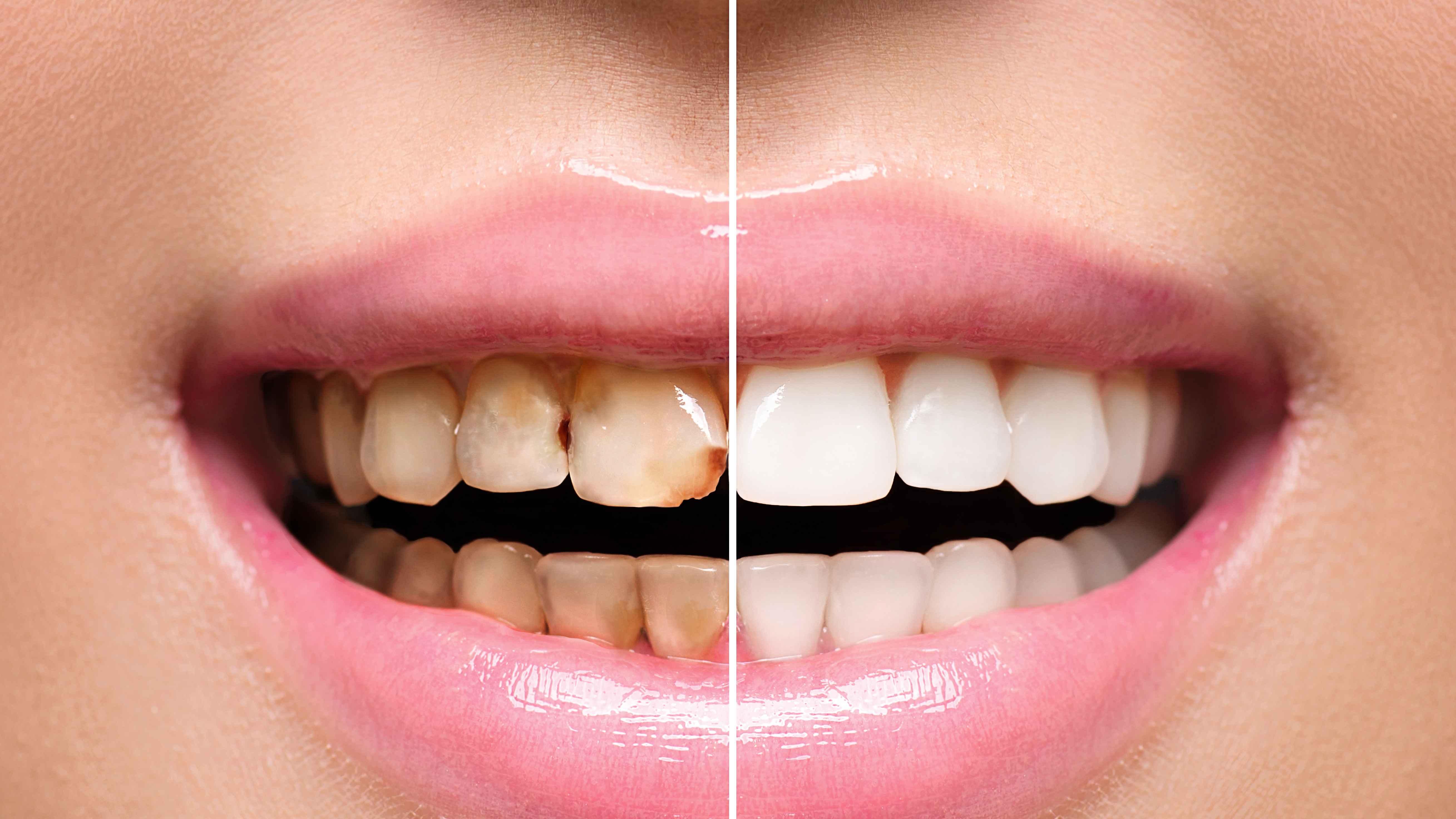 结肠癌|每天刷牙为何还会出现牙结石？牙结石究竟有何危害？一文科普