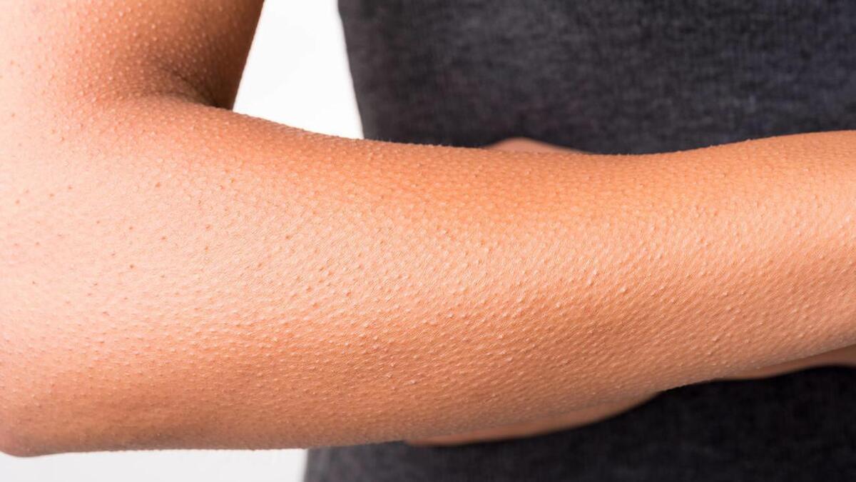 为什么我们会感到"鸡皮疙瘩"？