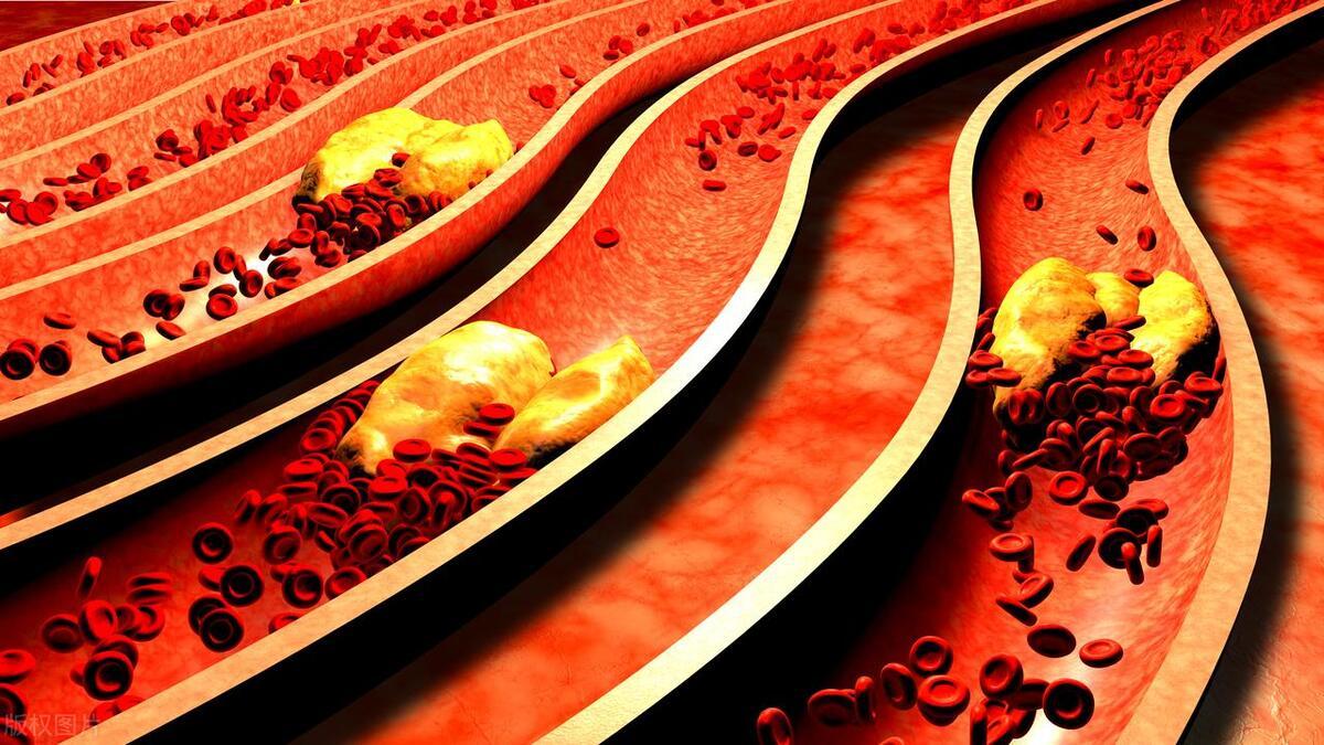 血管堵塞，身体有这2个异常，十有八九是血管堵了