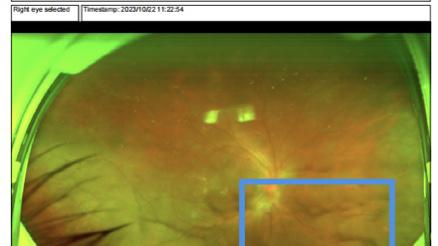 联合国糖尿病日 糖尿病患者应定期检查眼底