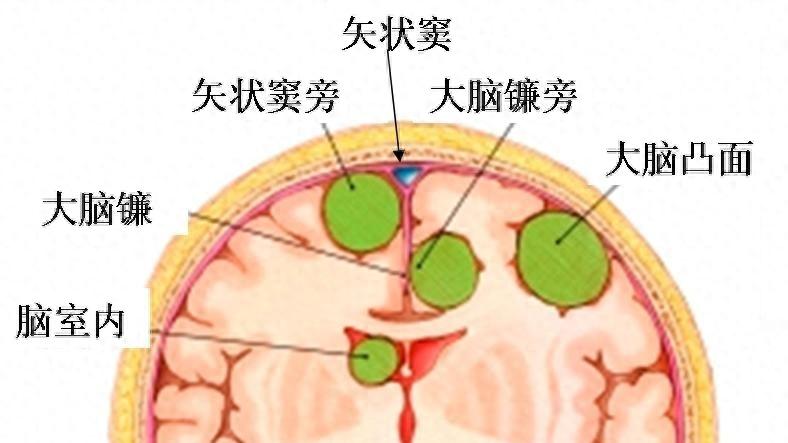 大叔突然失明！省肿瘤神外专家：脑瘤导致，要注意这9个信号