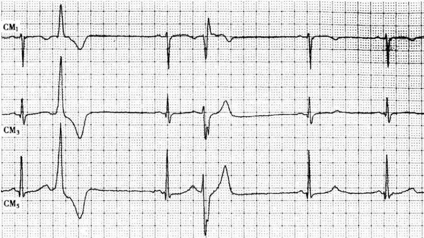 得了室性早搏，生活中有这些注意事项！
