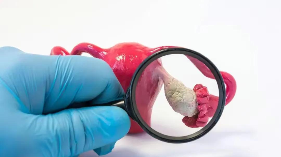 为什么卵巢癌一发现就是晚期？医生: 身体有5种异常，及时去检查