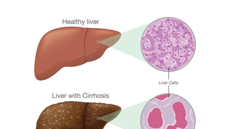 肝脏|从手掌、脸色、皮肤看出肝脏问题，守住5点防线，别让肝病转肝癌！