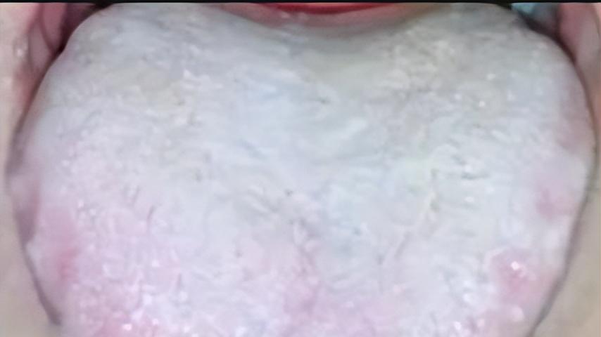 同为祛湿猛将，参苓白术散，二陈丸，六君子丸到底哪个更好