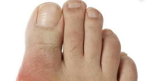 降尿酸“加速器”找到了，这3个小妙招或能派上大用场，不妨试试