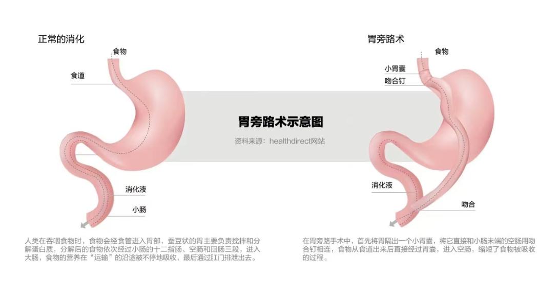 “胃转流”手术是如何致人伤残的？