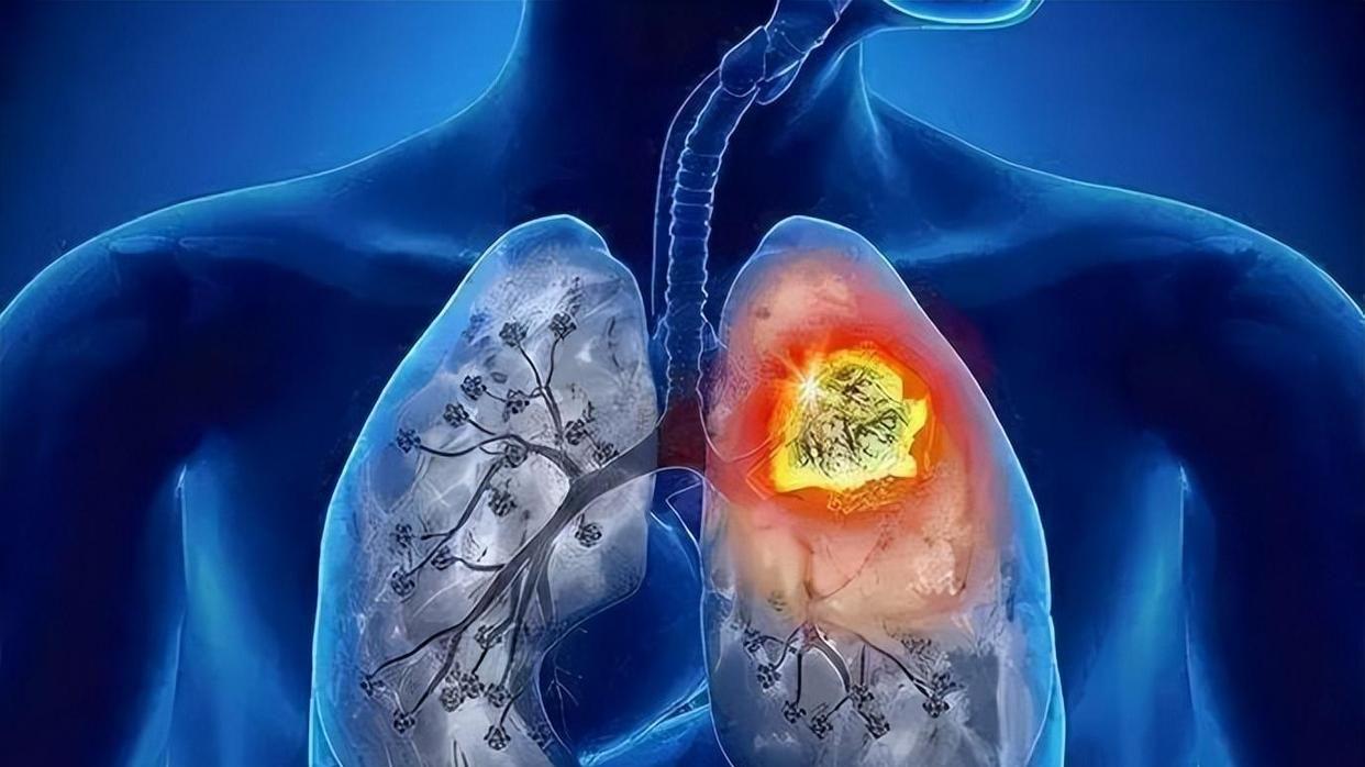 肺癌|肺部病变，“喉咙”先知？医生：若有3大异常，建议早做肺CT筛查