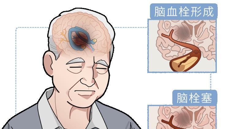 体内有疾，睡眠先知？睡觉时若出现4种异常，当心是脑梗预警