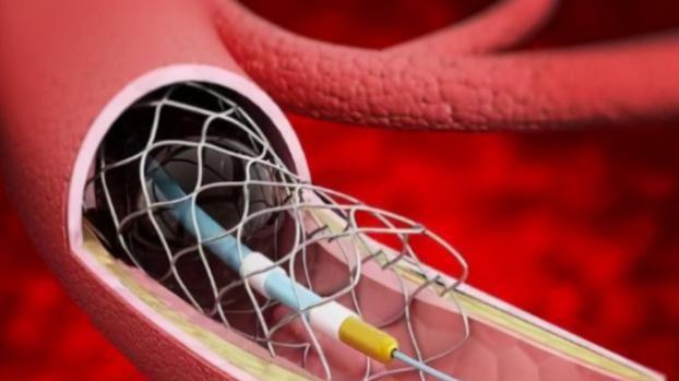 心脏|装上心脏支架后，还能活多少年呢？医生不再隐瞒，请提前告诉家人