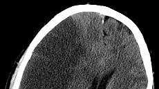 发病后1年复发率高达8.2%，5年高达41%？医生用数字带您了解卒中