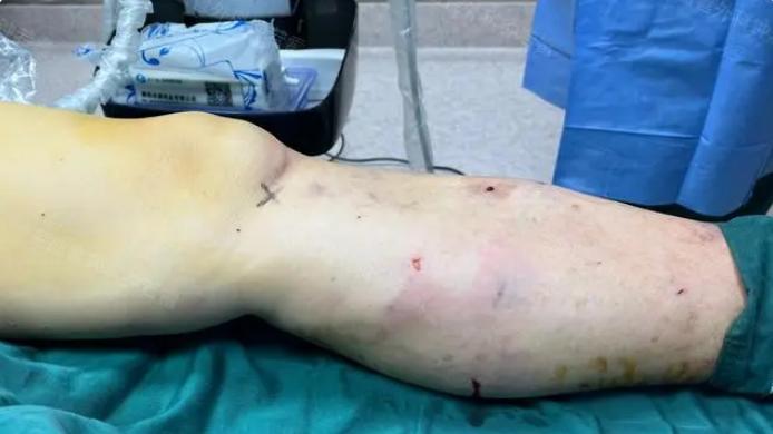 46岁初中老师，花一个月工资做静脉曲张微创，30分钟后腿成了这样