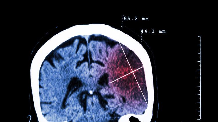 无端端有8种异常表现，十有八九是脑梗“求救”信号，尽早查CT