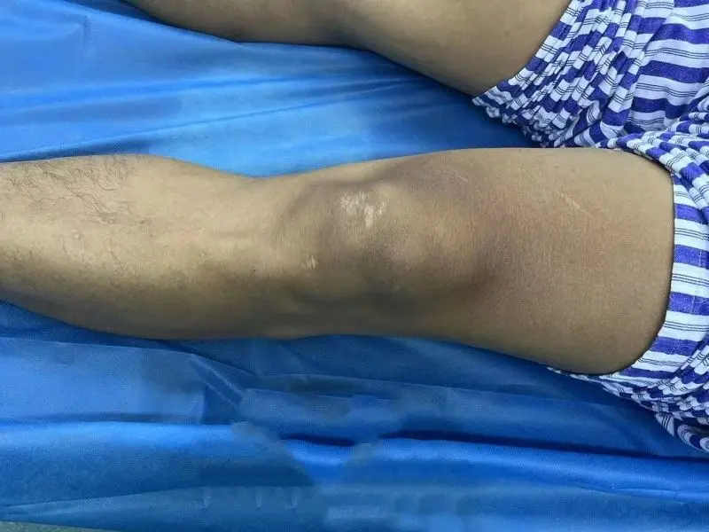 脚上长包块是不是痛风石？