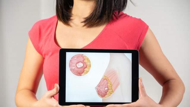 乳腺癌淋巴转移后，如何缩小肿块？一个古方4味中药，软坚散结