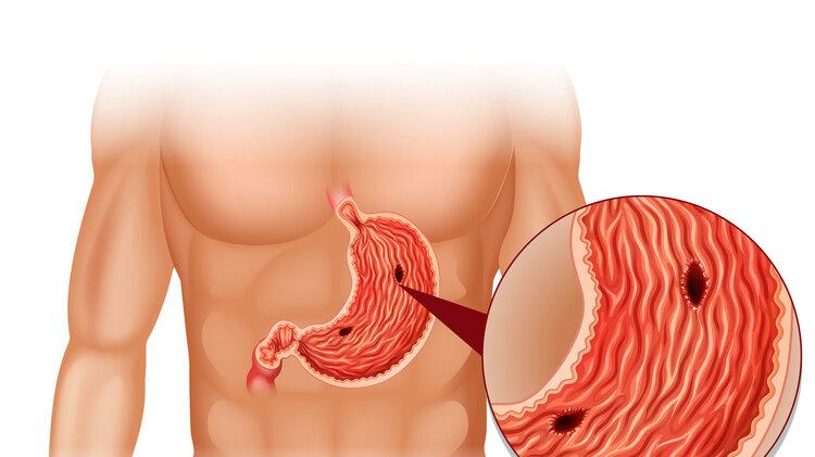 从查出胃溃疡到胃癌，仅半年！身体出现5个症状，可能是胃在呼救