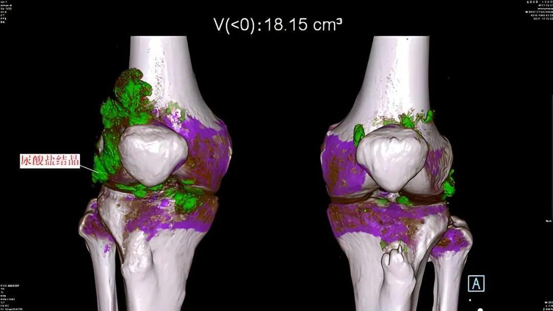 为何尿酸正常，痛风也不好还发作？痛风专家张卓解答！