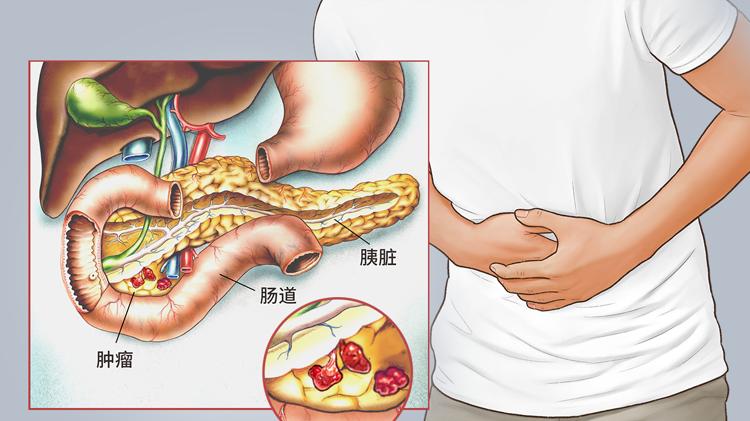 47岁男子每天大便两三次，确诊胰腺癌！5种异常或是身体“警报”