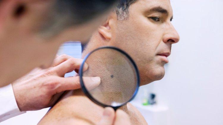 一再提醒：痣长在这3个位置，与癌症“密不可分”，赶紧自查