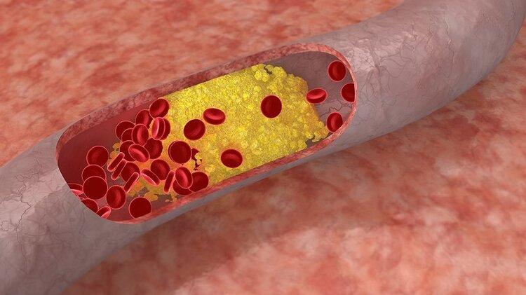 63岁男子坚持不吃晚餐，清除斑块、软化血管，半年后效果如何？