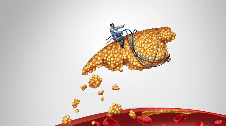 血脂高的5个信号，有些人没当回事，血管就堵了！